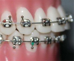 Orthodontic BRACKET and TUBE Mini Roth MBT LASER MARK IN BASE Upper Lower 28pcs