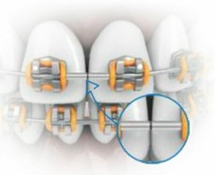 100Pcs Dental Orthodontic Mini Large Small Stops Stop Hook Stainless Steel