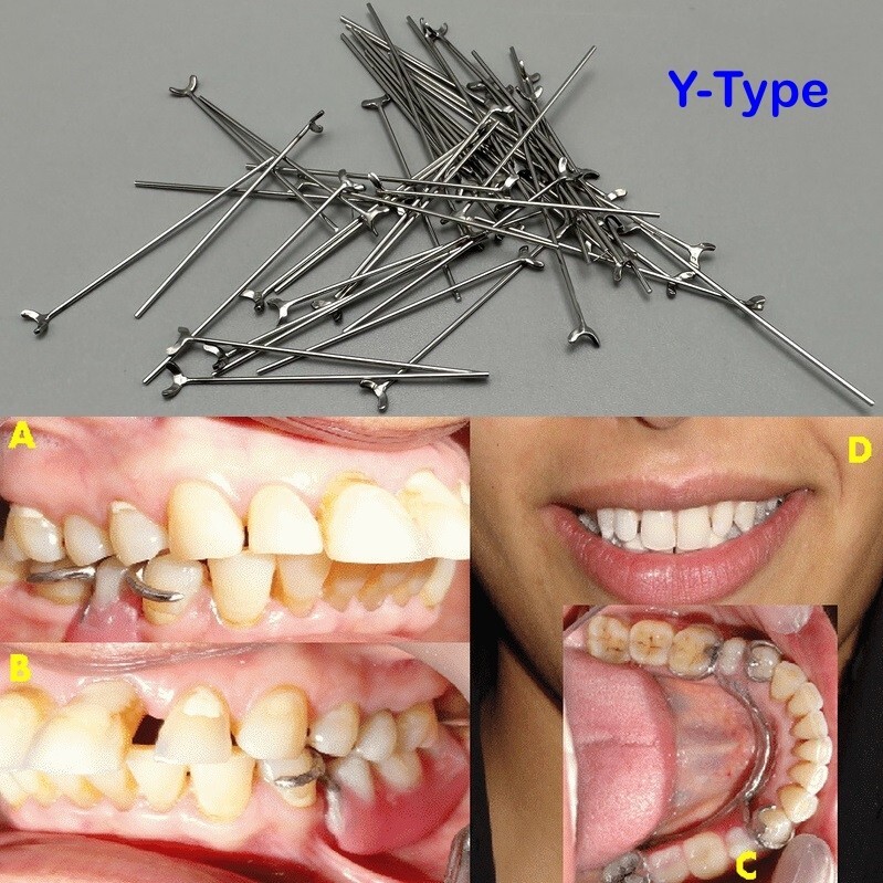 10Pcs Dental Ball Retainer J Clasp Oblique Clasps Bars Y-Type Scheu Style 0.7/8