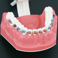 Dental High Quality Orthodontic Demonstration Model With Brackets Buccal Tubes
