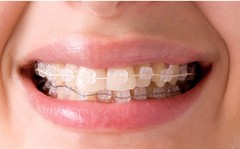 J&J Ortho™ CLARO™ Crystal Sapphire Orthodontic Bracket (12 Brackets) Hubit