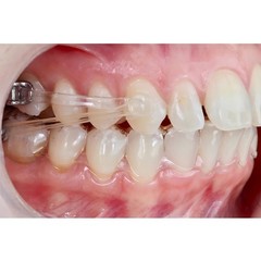 Orthodontic Class II Clear Distalizer Appliance Corrector 16 18 20 23 23 27mm