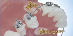 1bag10pcs Dental Orthodontic Traction Chain Gold Plated Round Buttons with Chain