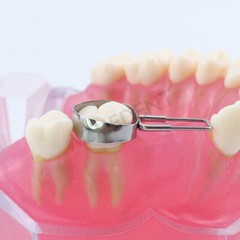 10-Size Dental Teeth Missing Maintainer Bands Space Retainer Band Molar Adjacent