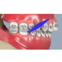 EASYINSMILE 100Pcs Dental Orthodontic Elastics Placer Rubber Bands Braces 6cm US