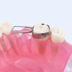 Dental Space Retainer Band Molar Adjacent Teeth Missing Maintainer Bands 1st 2nd
