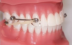 Orthodontic Class II Appliance Kit Corrector Carriere Bondable Rubber Bands