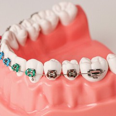 Dental High Quality Orthodontic Demonstration Model With Brackets Buccal Tubes