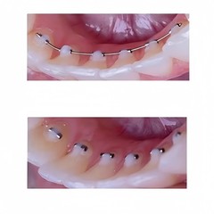 100Pcs Dental Orthodontic Crimpable Hook Stop tube Mini Stops Bracket Stopper