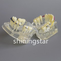 Dental Orthodontic Teeth Model Study Treatment Demo Bracket Wire Ligature 3005-2