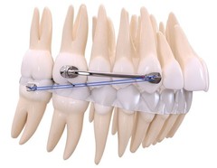 Dental Orthodontic Class II Appliance Kit Distalizer Corrector Bondable Rubber