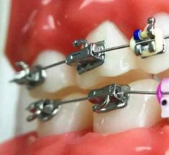 U Ortho Weldable Buccal Tubes -1st Molar MBT 0.022 Free Shipping Worldwide