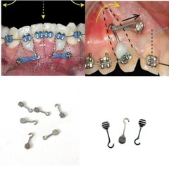 Dental Bonding Crimpable Hook Orthodontic Adhesive Hooks Arch Wire Left+Right