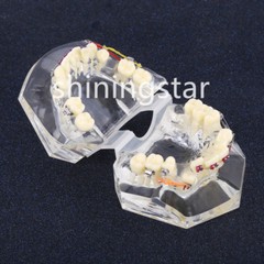Dental Orthodontic Treatment Teeth Model Malocclusion Study Brackets Demo 3005-3